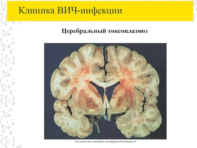 Клиника ВИЧ-инфекции Церебральный токсоплазмоз