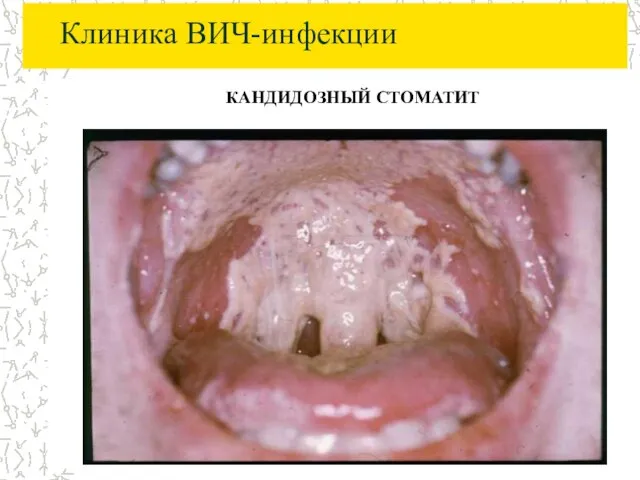 Клиника ВИЧ-инфекции КАНДИДОЗНЫЙ СТОМАТИТ