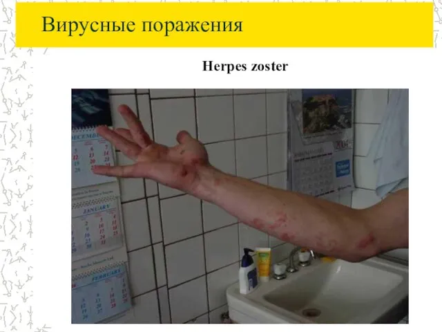 Вирусные поражения Herpes zoster