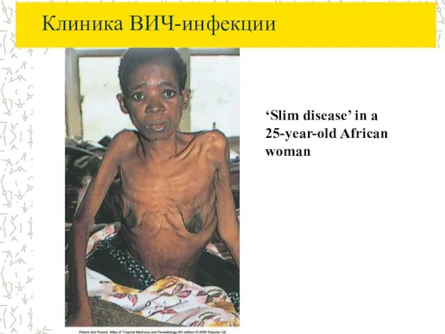 Клиника ВИЧ-инфекции ‘Slim disease’ in a 25-year-old African woman