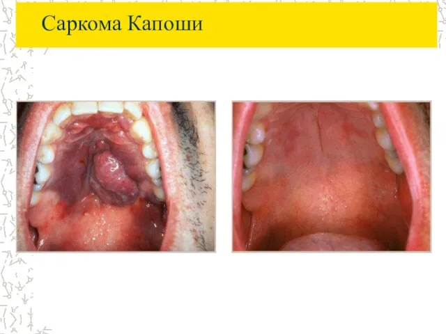 Саркома Капоши