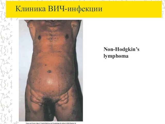 Клиника ВИЧ-инфекции Non-Hodgkin’s lymphoma