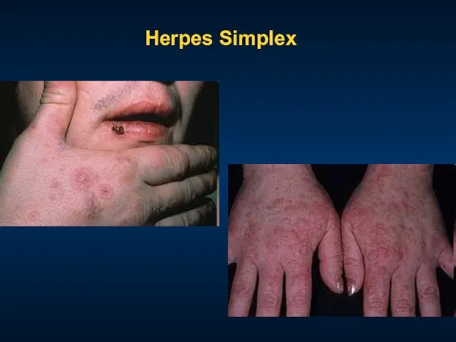 Herpes Simplex