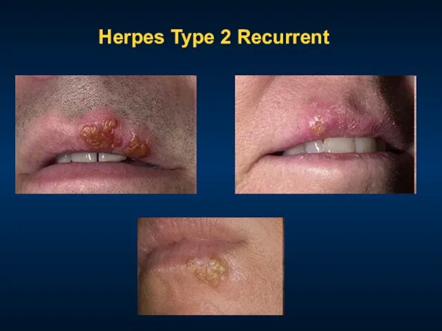 Herpes Type 2 Recurrent