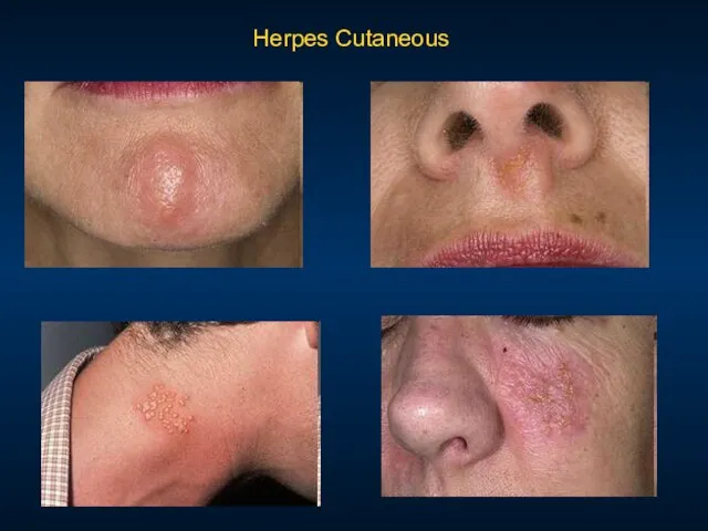 Herpes Cutaneous