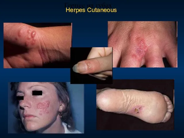 Герпес на губах. Herpes Cutaneous