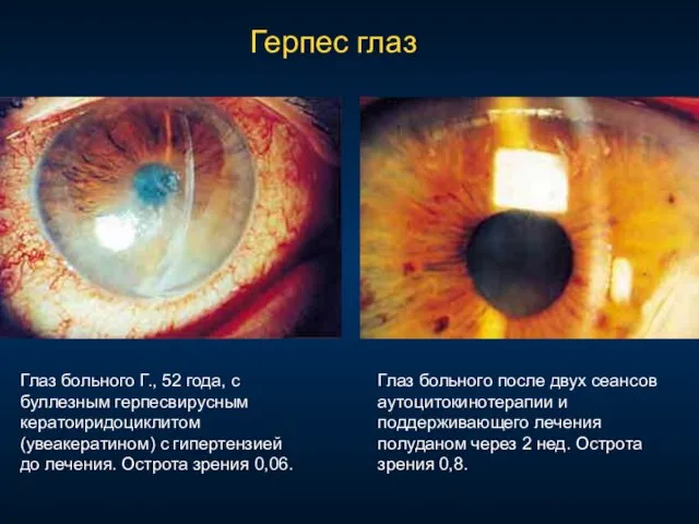 Глаз больного Г., 52 года, с буллезным герпесвирусным кератоиридоциклитом (увеакератином) с гипертензией
