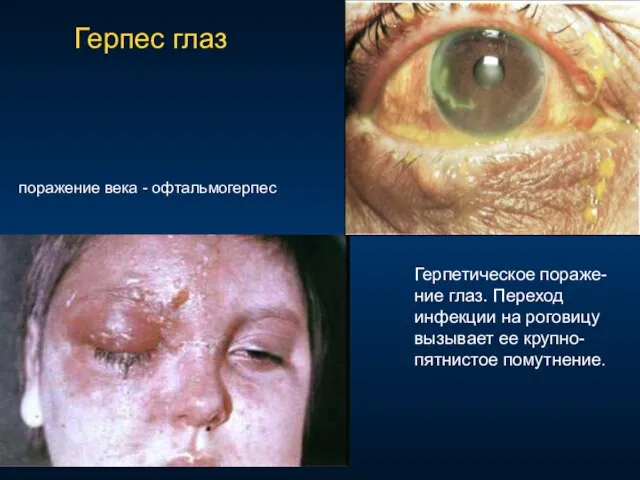 Герпес глаз поражение века - офтальмогерпес Герпетическое пораже-ние глаз. Переход инфекции на