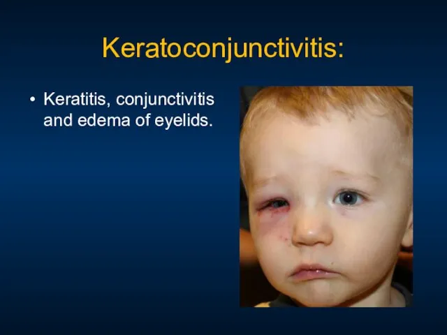 Keratoconjunctivitis: Keratitis, conjunctivitis and edema of eyelids.