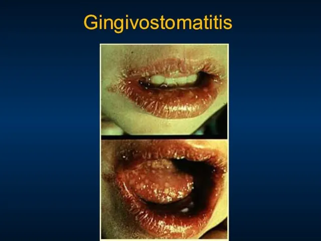 Gingivostomatitis