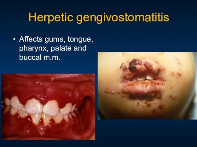 Herpetic gengivostomatitis Affects gums, tongue, pharynx, palate and buccal m.m.