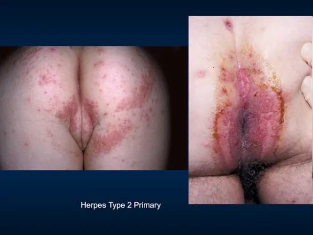 Herpes Type 2 Primary