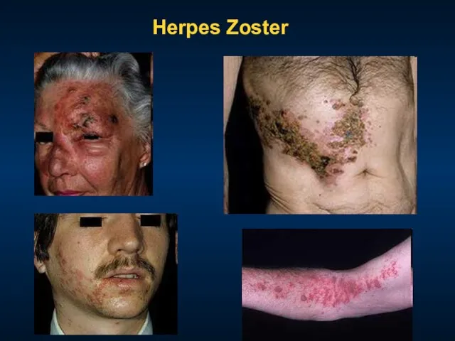 Herpes Zoster