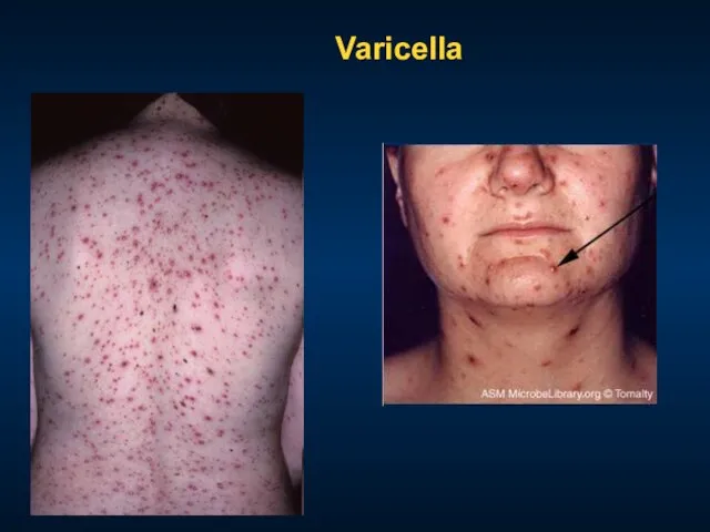 Varicella