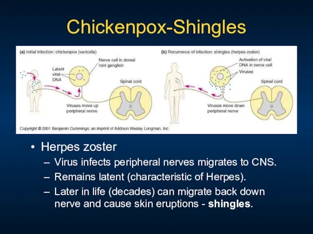 Chickenpox-Shingles Herpes zoster Virus infects peripheral nerves migrates to CNS. Remains latent