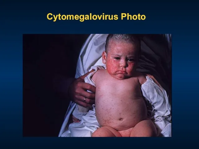 Cytomegalovirus Photo