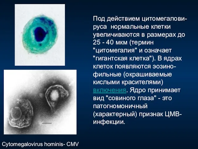 Под действием цитомегалови-руса нормальные клетки увеличиваются в размерах до 25 - 40