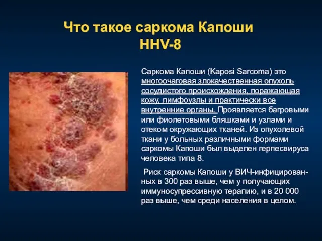 Что такое саркома Капоши HHV-8 Саркома Капоши (Kaposi Sarcoma) это многоочаговая злокачественная