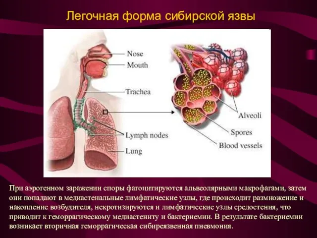 Легочная форма сибирской язвы При аэрогенном заражении споры фагоцитируются альвеолярными макрофагами, затем