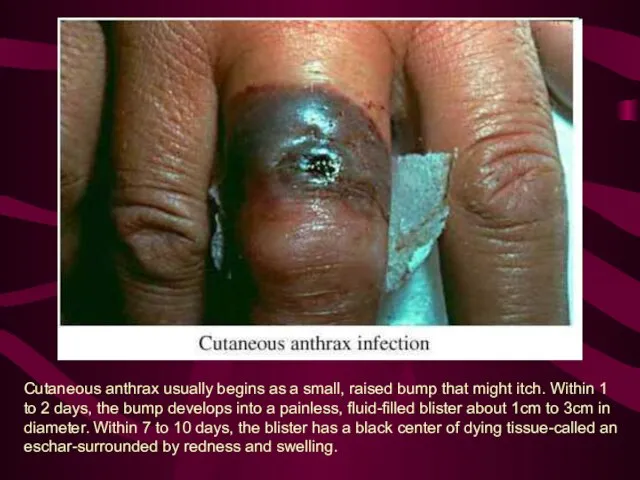 Cutaneous anthrax usually begins as a small, raised bump that might itch.