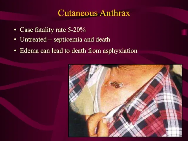 Cutaneous Anthrax Case fatality rate 5-20% Untreated – septicemia and death Edema