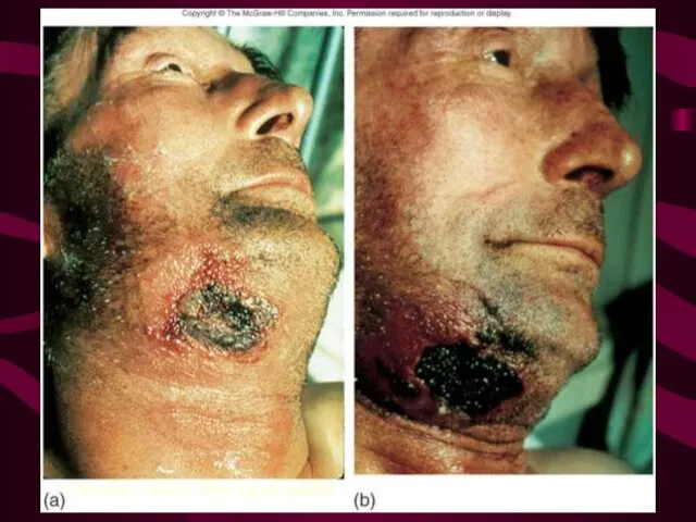 Cutaneous anthrax showing the eschar