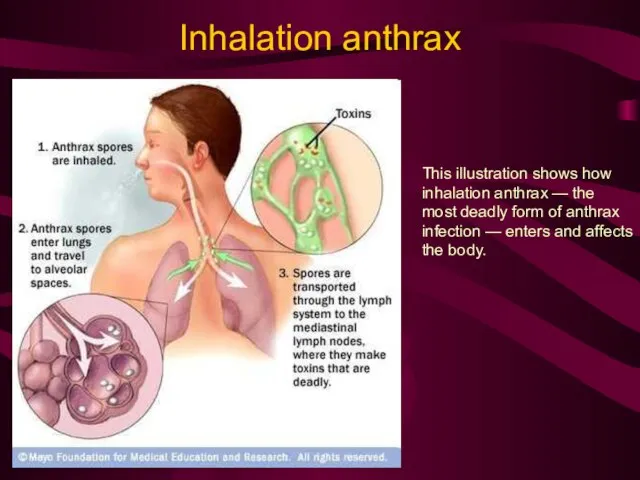 Inhalation anthrax This illustration shows how inhalation anthrax — the most deadly