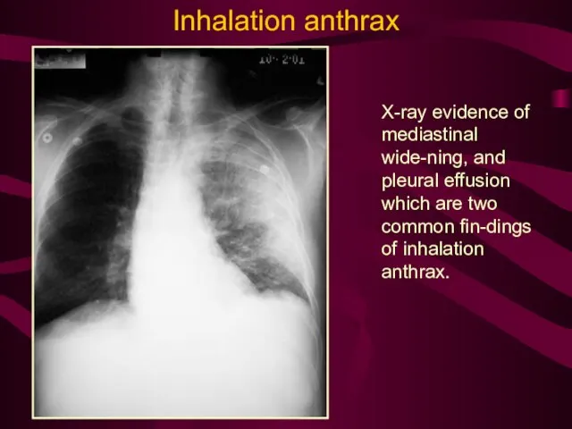 X-ray evidence of mediastinal wide-ning, and pleural effusion which are two common