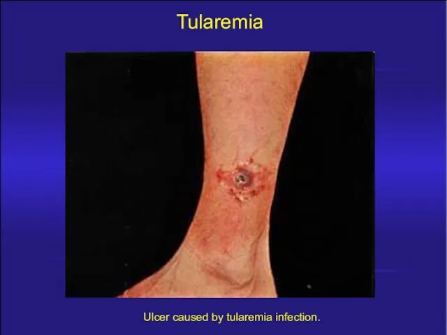 Tularemia Ulcer caused by tularemia infection.