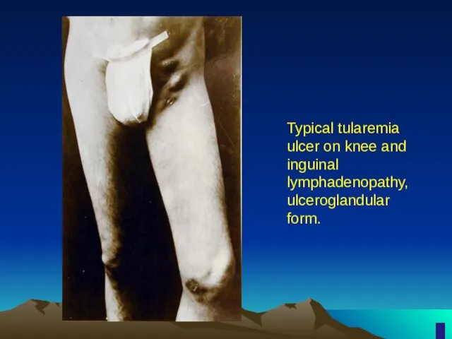 Typical tularemia ulcer on knee and inguinal lymphadenopathy, ulceroglandular form.
