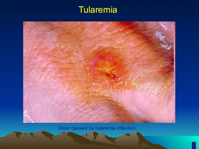 Tularemia Ulcer caused by tularemia infection.