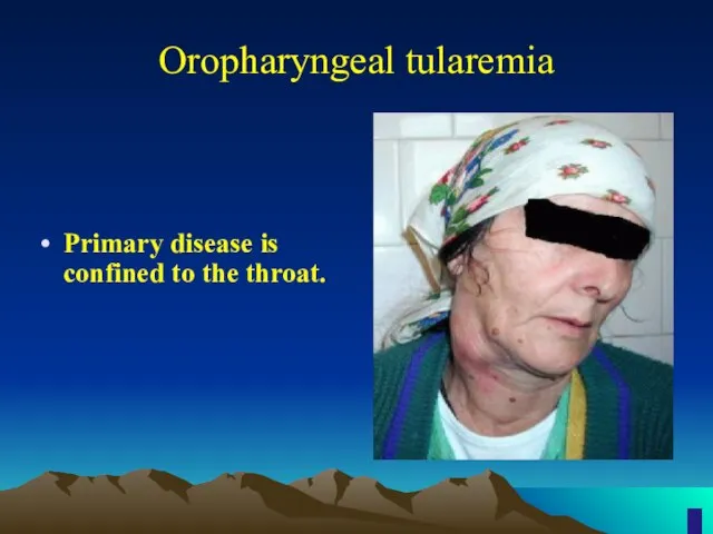 Oropharyngeal tularemia Primary disease is confined to the throat.