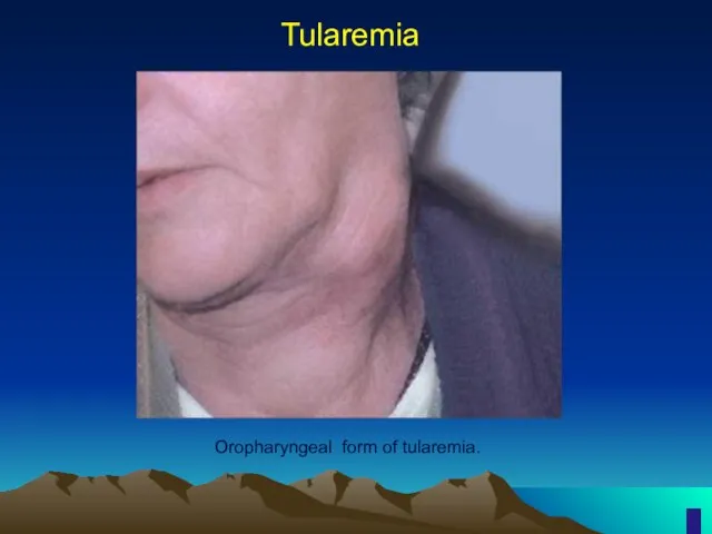 Tularemia Oropharyngeal form of tularemia.