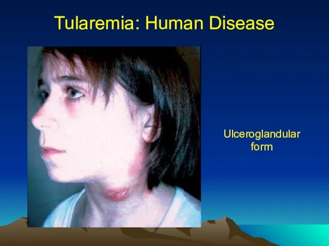 Tularemia: Human Disease Ulceroglandular form