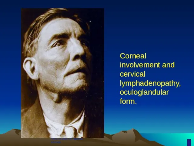 Photo courtesy of National Archives Corneal involvement and cervical lymphadenopathy, oculoglandular form.
