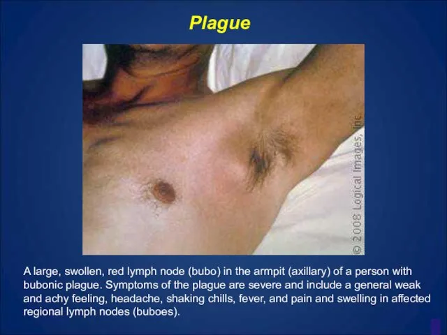 A large, swollen, red lymph node (bubo) in the armpit (axillary) of