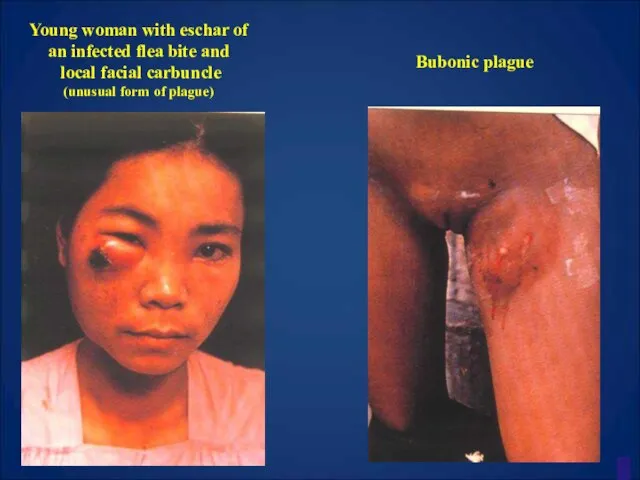 Young woman with eschar of an infected flea bite and local facial