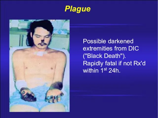 Plague Possible darkened extremities from DIC ("Black Death"). Rapidly fatal if not Rx'd within 1st 24h.