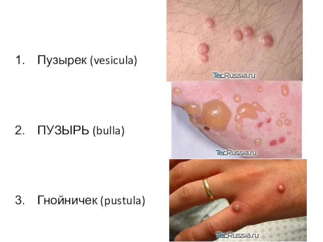 Пузырек (vesicula) ПУЗЫРЬ (bulla) Гнойничек (pustula)