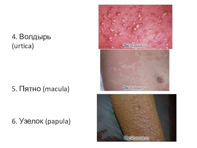 4. Волдырь (urtica) 5. Пятно (macula) 6. Узелок (papula)