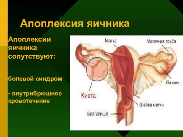 Апоплексия яичника Апоплексии яичника сопутствуют: болевой синдром - внутрибрюшное кровотечение