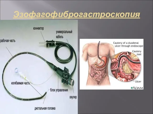 Эзофагофиброгастроскопия