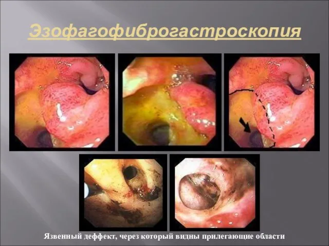 Эзофагофиброгастроскопия Язвенный деффект, через который видны прилегающие области