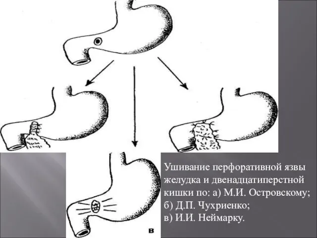 Ушивание перфоративной язвы желудка и двенадцатиперстной кишки по: а) М.И. Островскому; б)