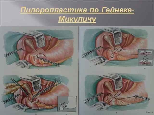 Пилоропластика по Гейнеке-Микуличу