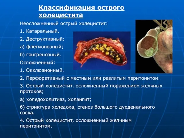 Классификация острого холецистита Неосложненный острый холецистит: 1. Катаральный. 2. Деструктивный: а) флегмонозный;