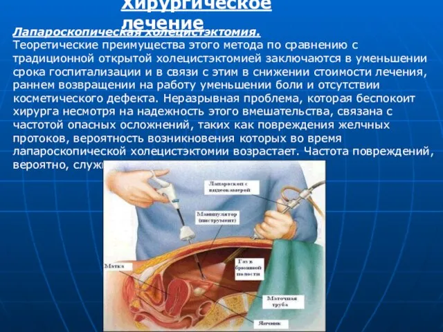 Хирургическое лечение Лапароскопическая холецистэктомия. Теоретические преимущества этого метода по сравнению с традиционной