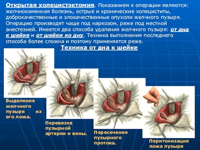 Открытая холецистэктомия. Показанием к операции являются: желчнокаменная болезнь, острые и хронические холециститы,