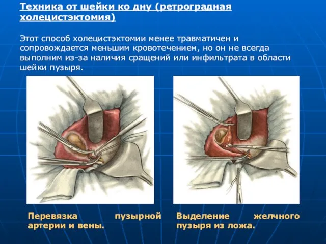 Техника от шейки ко дну (ретроградная холецистэктомия) Этот способ холецистэктомии менее травматичен