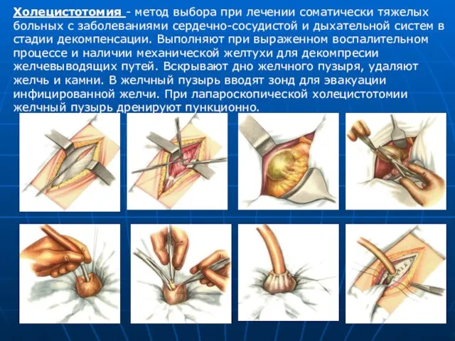 Холецистотомия - метод выбора при лечении соматически тяжелых больных с заболеваниями сердечно-сосудистой